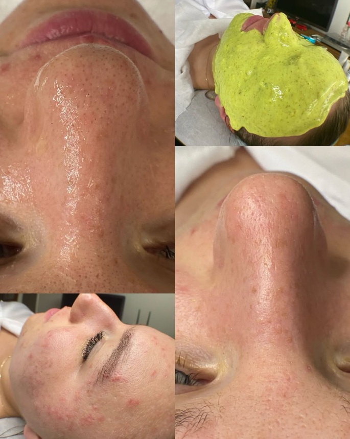 The First Step Toward Clearer, Healthier Skin